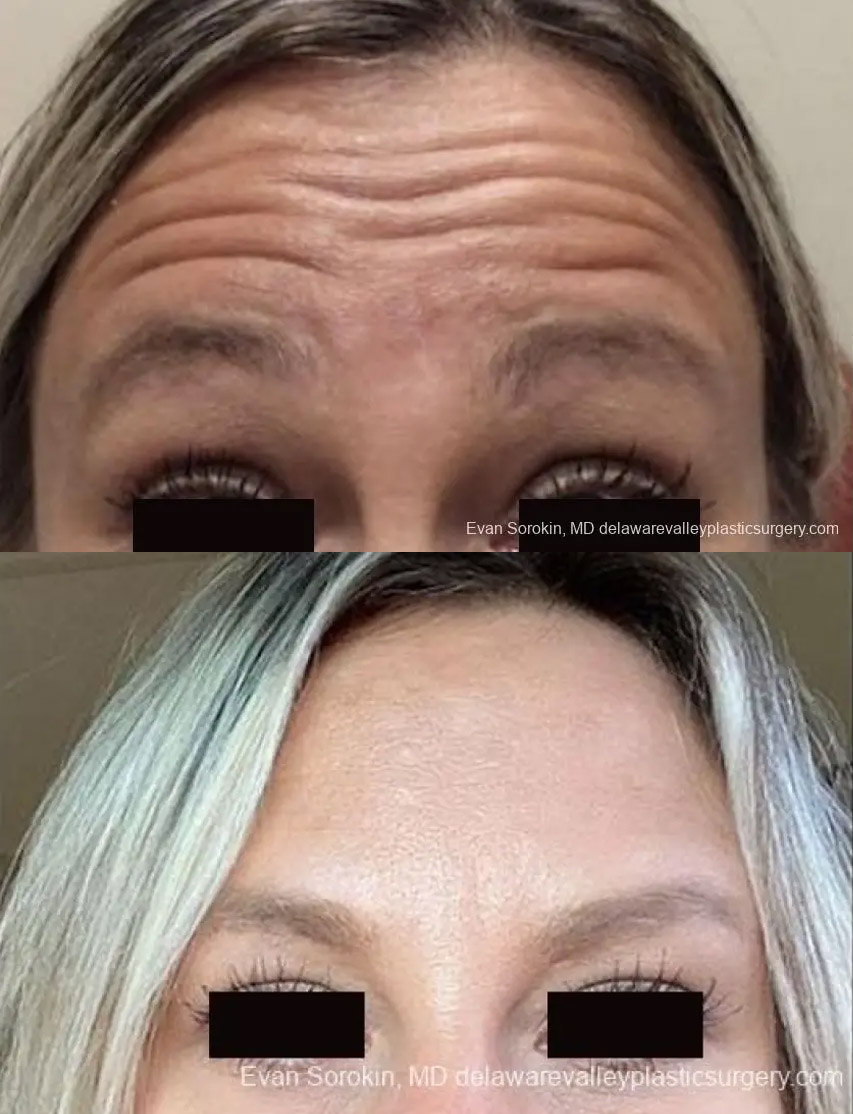 botox cosmetic before and after
